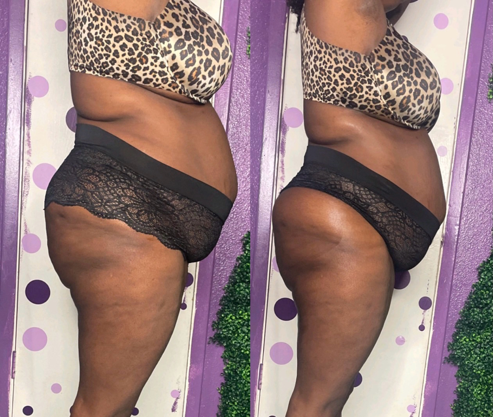 Non-Surgical Lip & Skin Tighten 30m