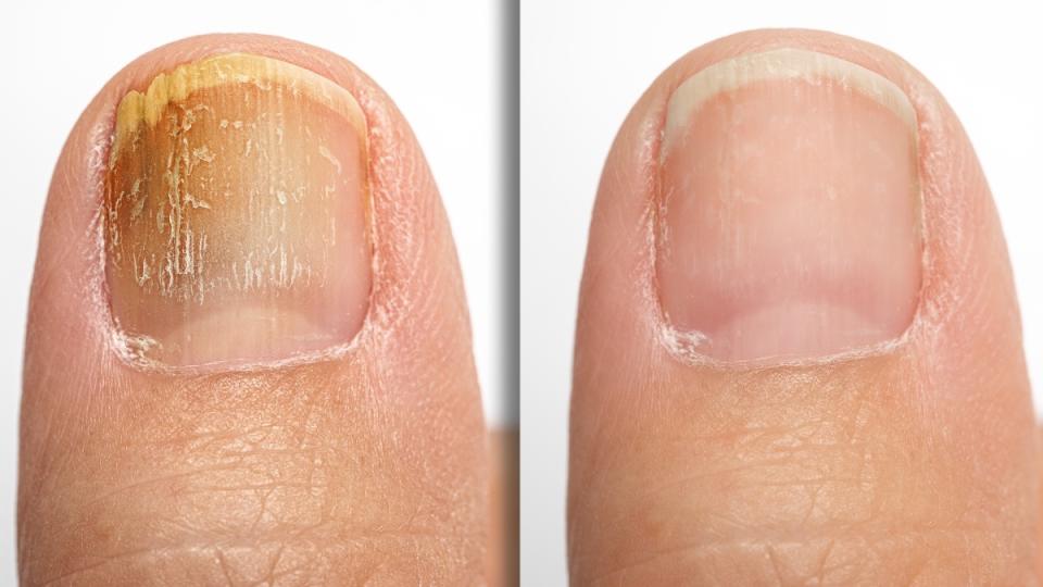 Fungus Treatment(finger /toes Nail)