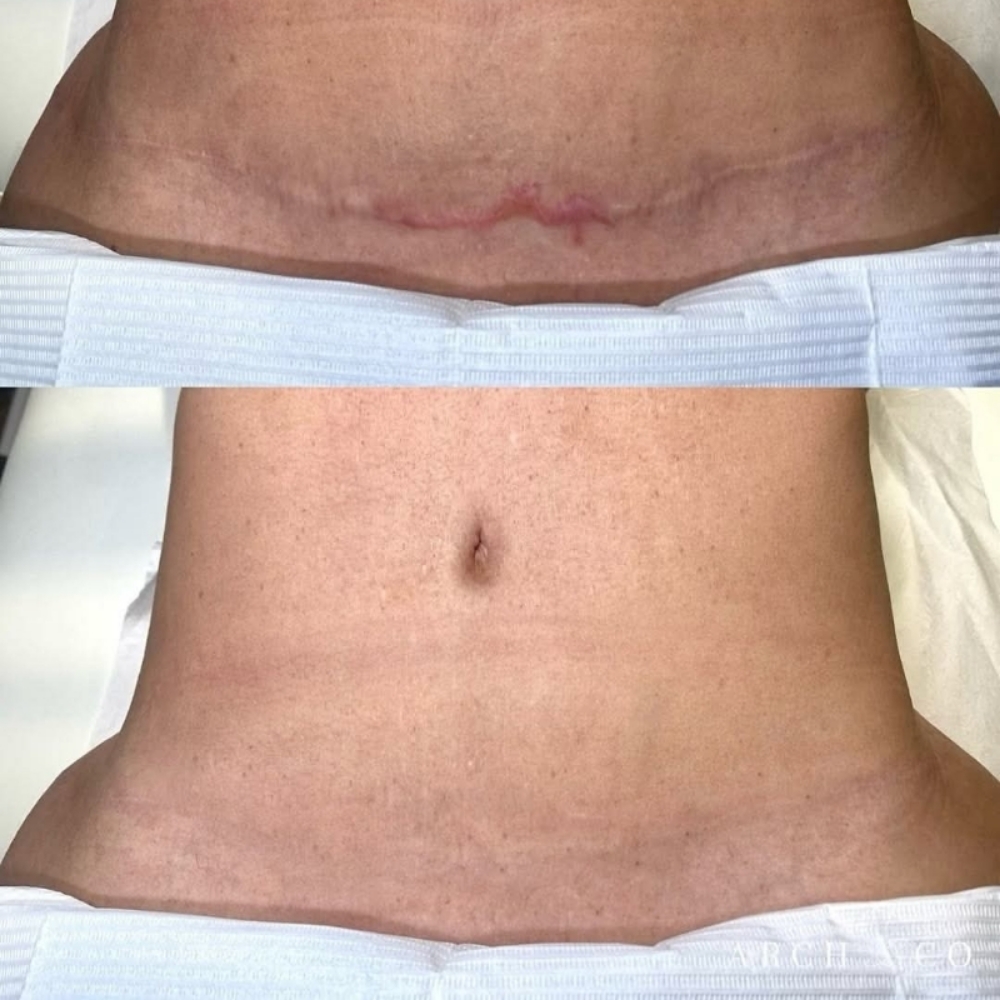 Scar Camouflage at Mobile Bliss By Shar, LLC in Rochester, NY