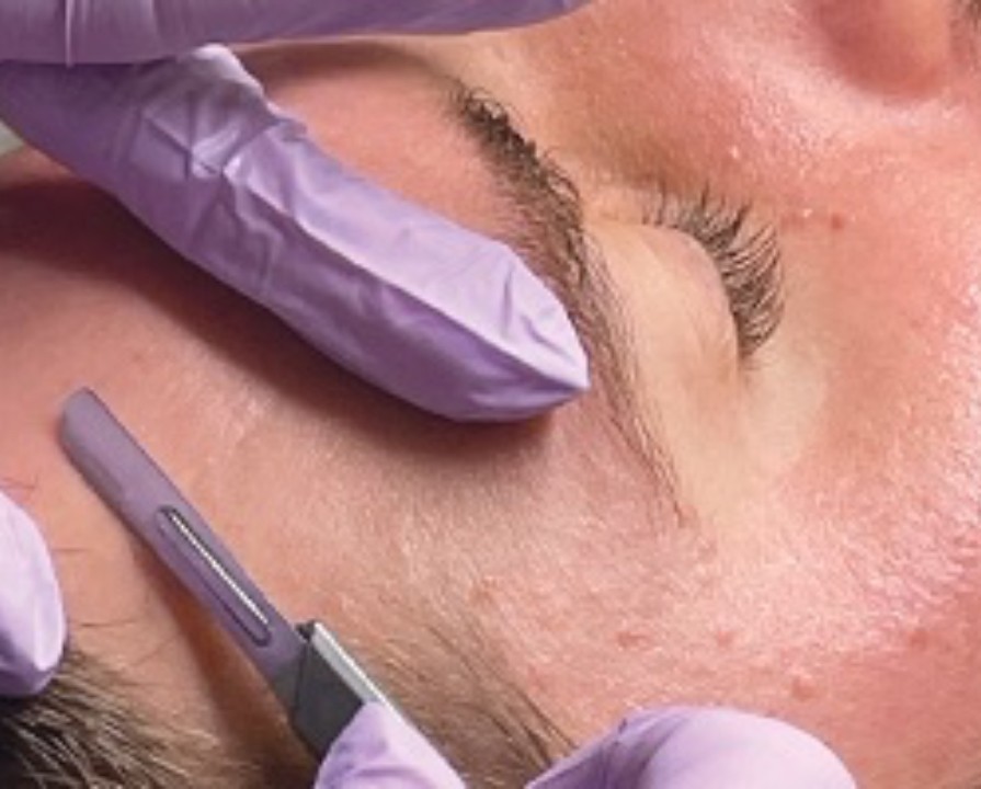 Dermaplaning