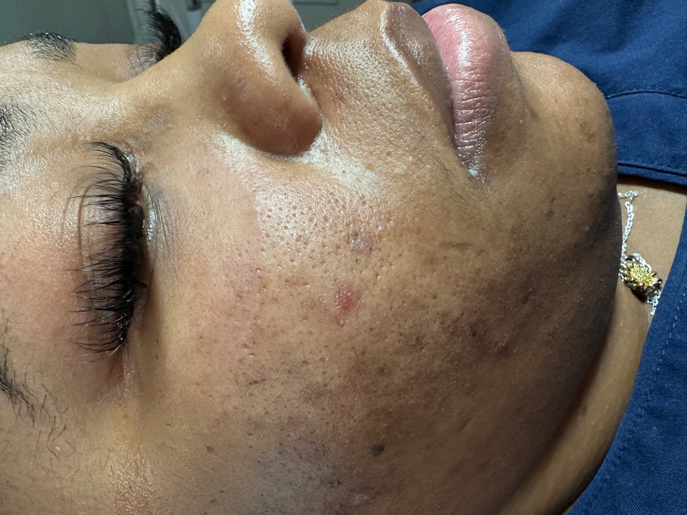 Lash Fill