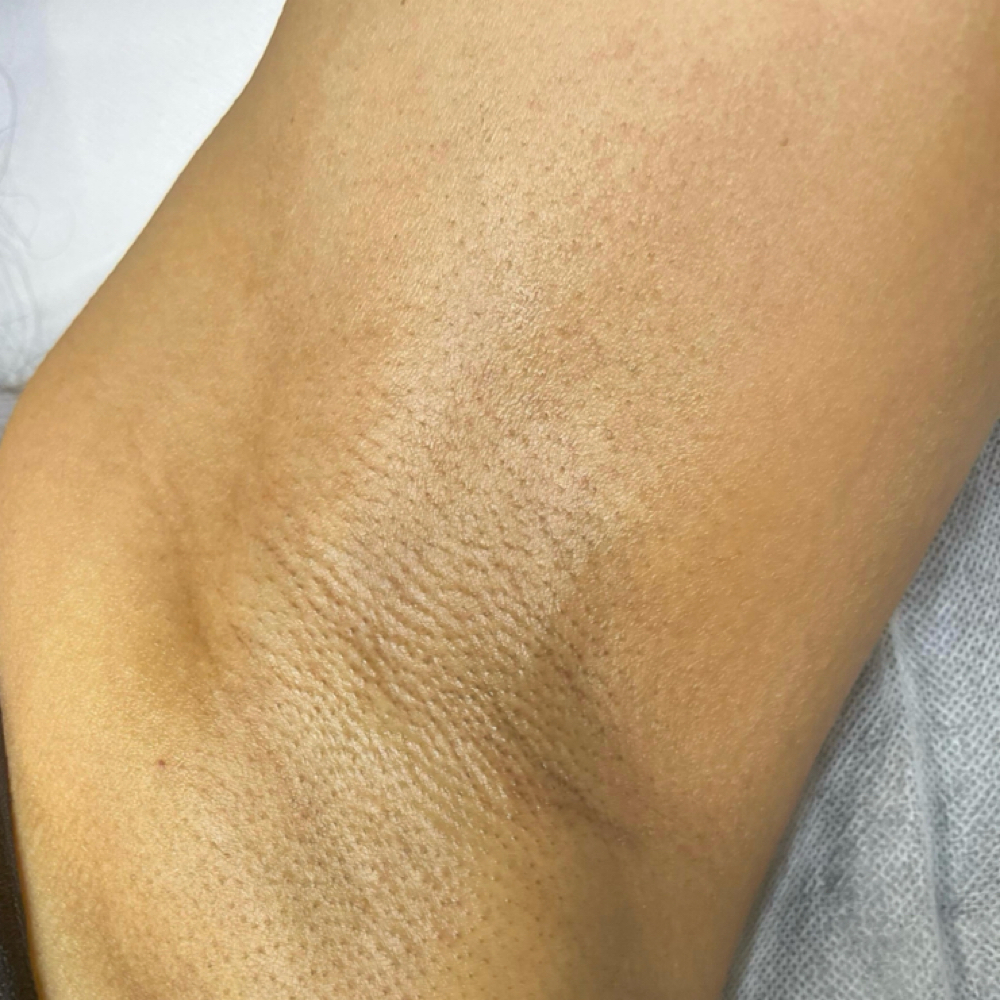Underarms at Rosy Radinace in Edgewater, CO