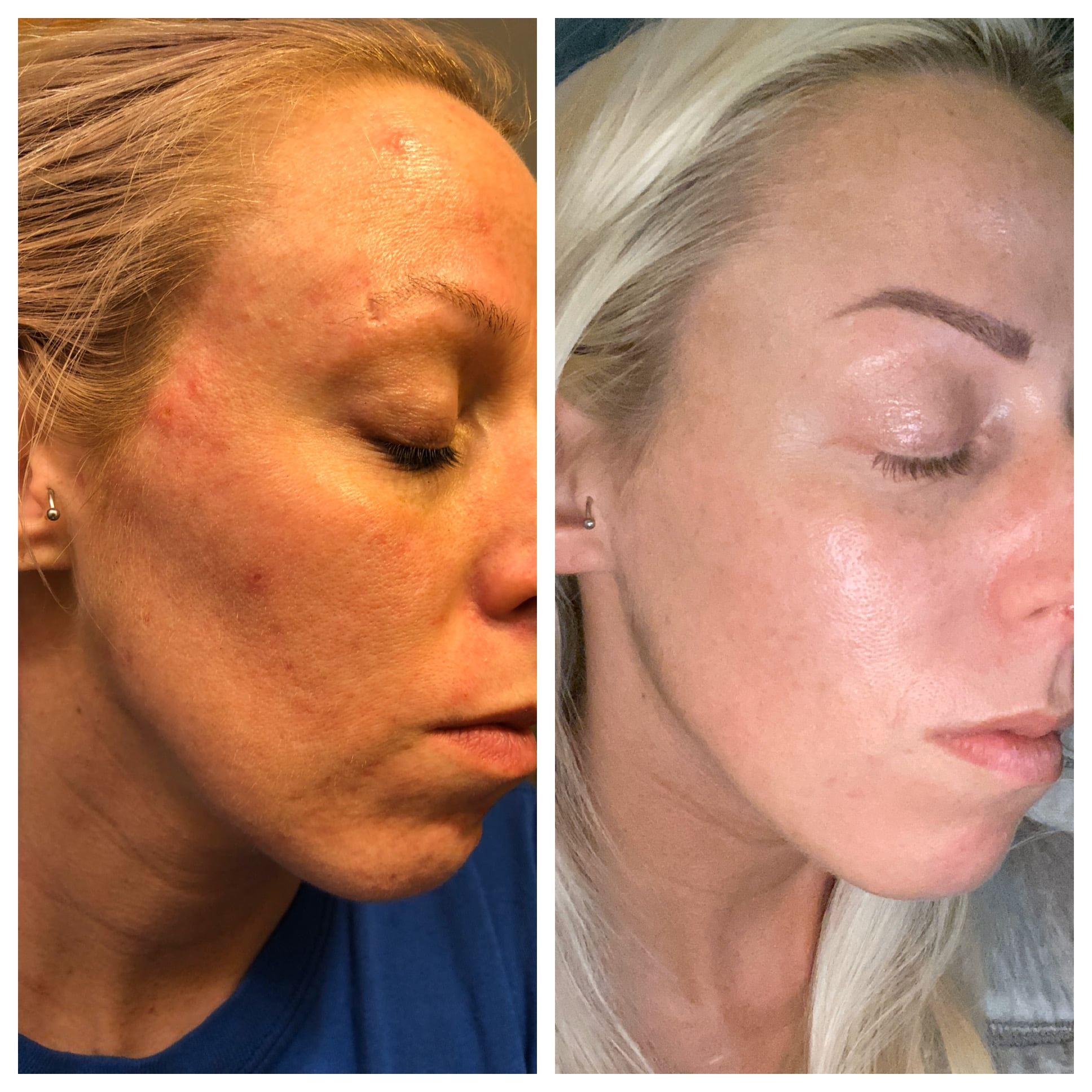 Growth Factor Micro Needling at Jennifer Marie Skincare in Elkhart, IN