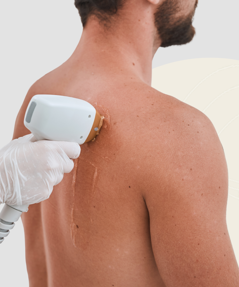 Laser Full Back at Loba Beauty Spa in Paterson, NJ
