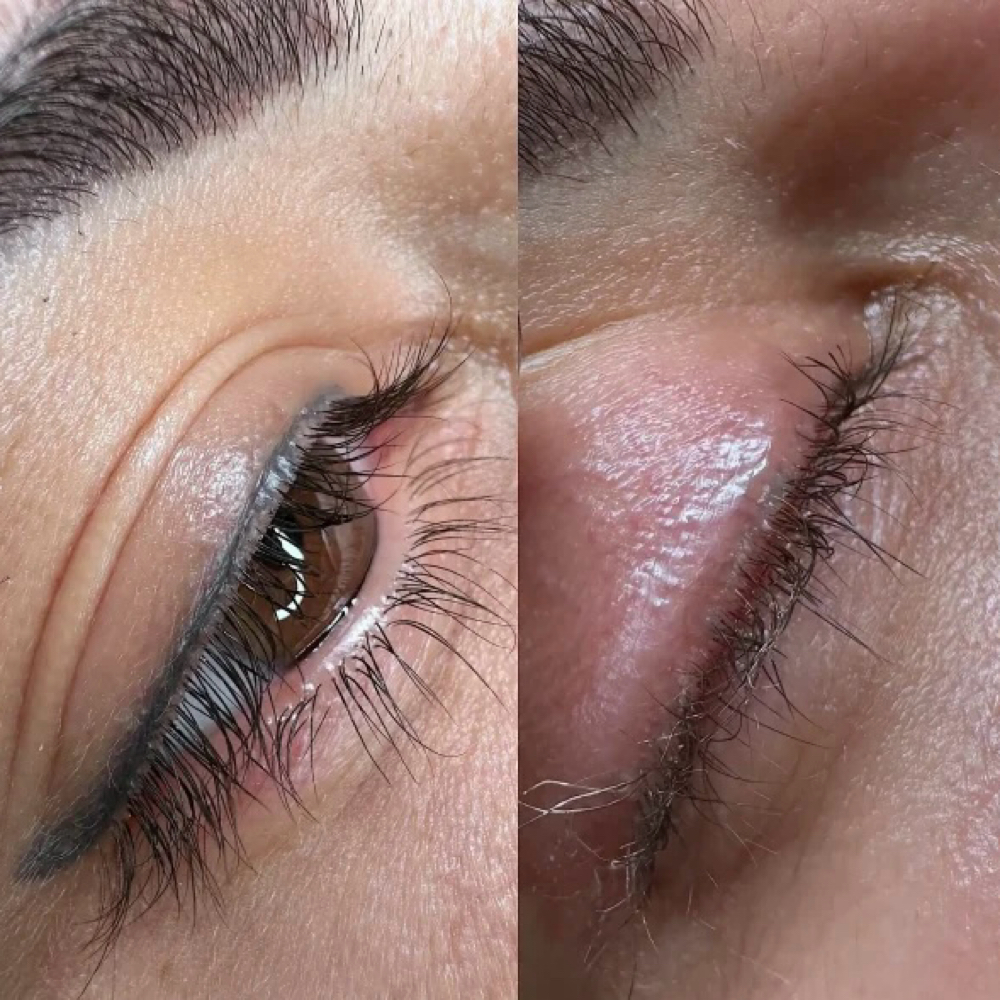 Laser PMU Removal- Eyeliner at Meraki Artistry in Greenwood, IN