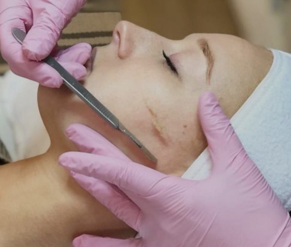 DERMAPLANING