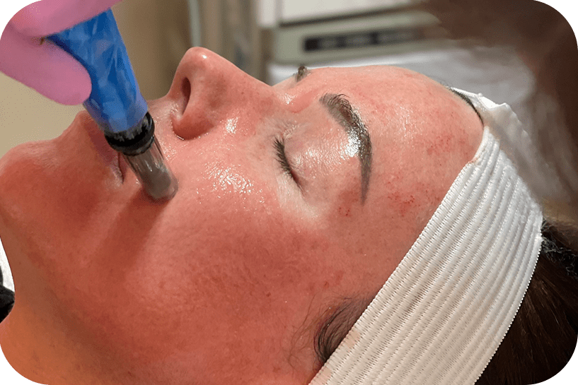 Microneedling CIT