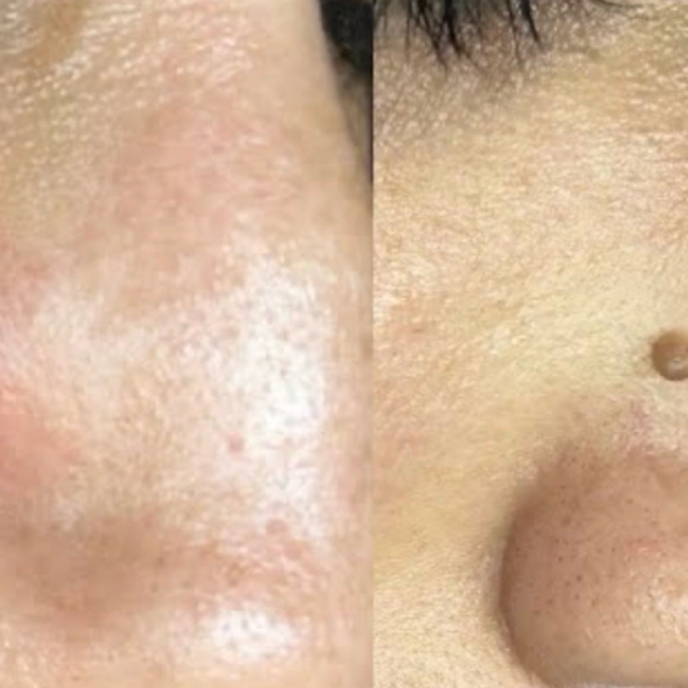 Fibroblast Therapy at Auroura Skin & Smile in Worcester, MA