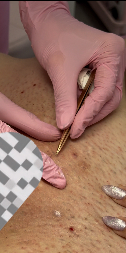 Ingrown removal add-on at Nani’s Aesthetics in Miami, FL