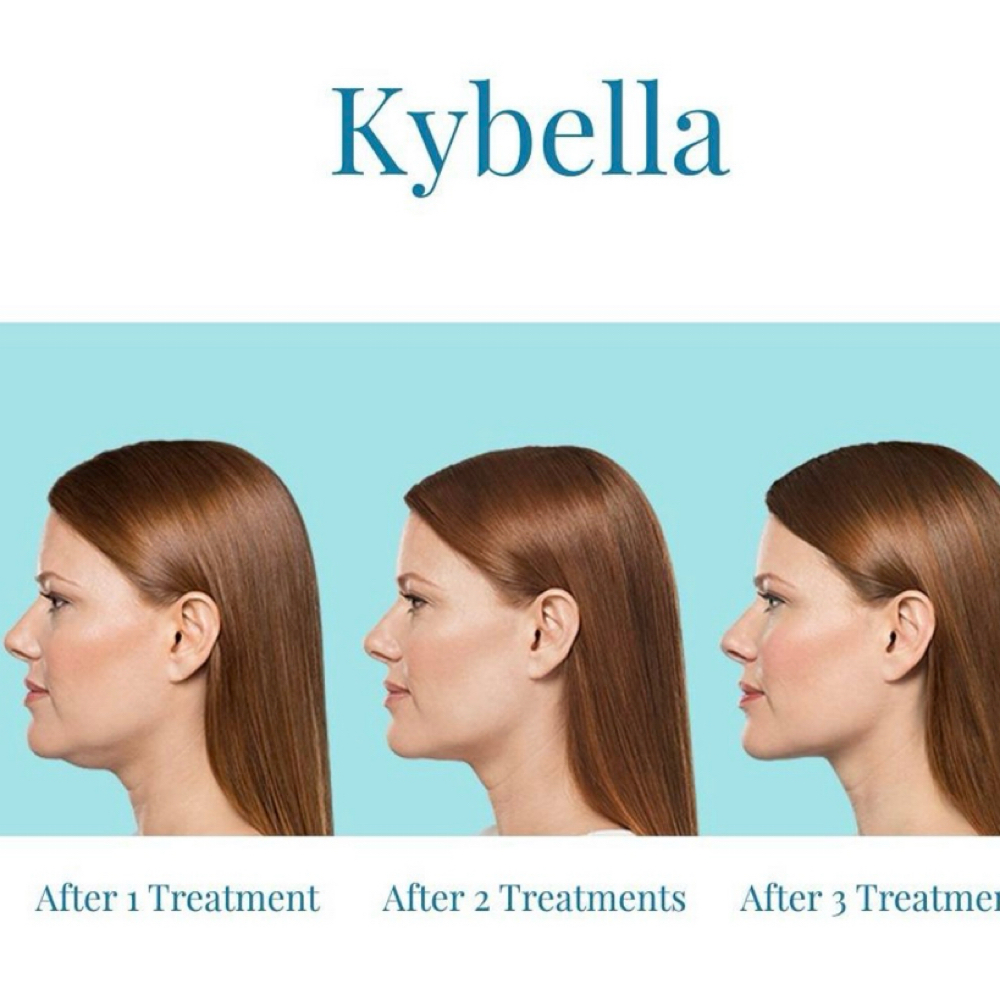 Kybella Treatments at Brenda Willis Enterprises in Leesville, LA