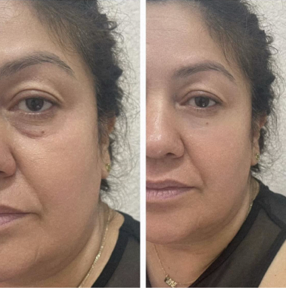 👁 UNDER EYE FILLER at Flawless Spa & Beauty in Fort Worth, TX