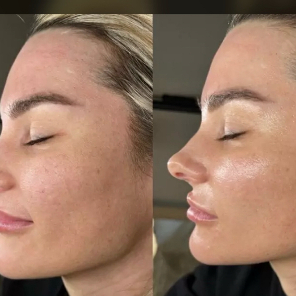Add Ons | DermaPlane at Aura Atelier in Charlotte, NC