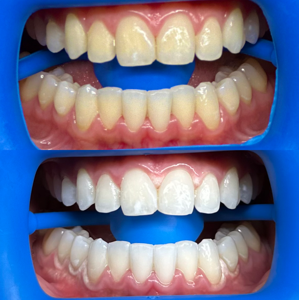 🦷90min Teeth Whitening Session