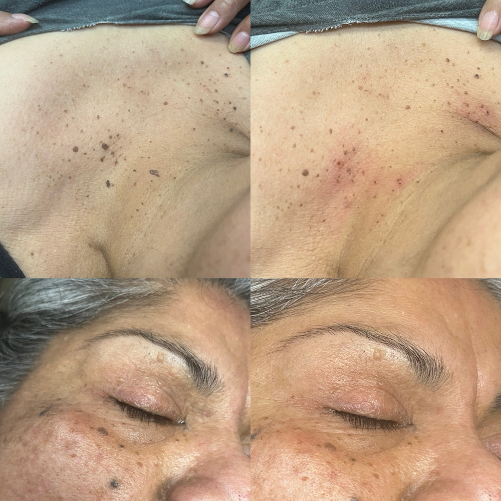Skin Tag Removal