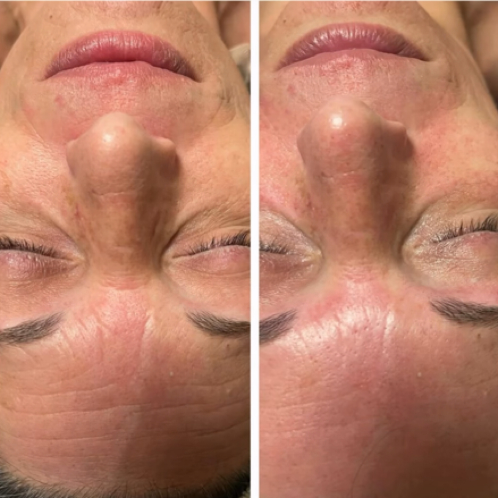 ProCell Microchanneling at The Skintique Day Spa in Wayland, MA