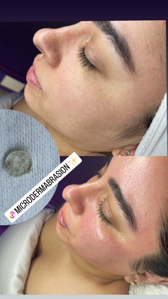 Classic Microdermabrasion