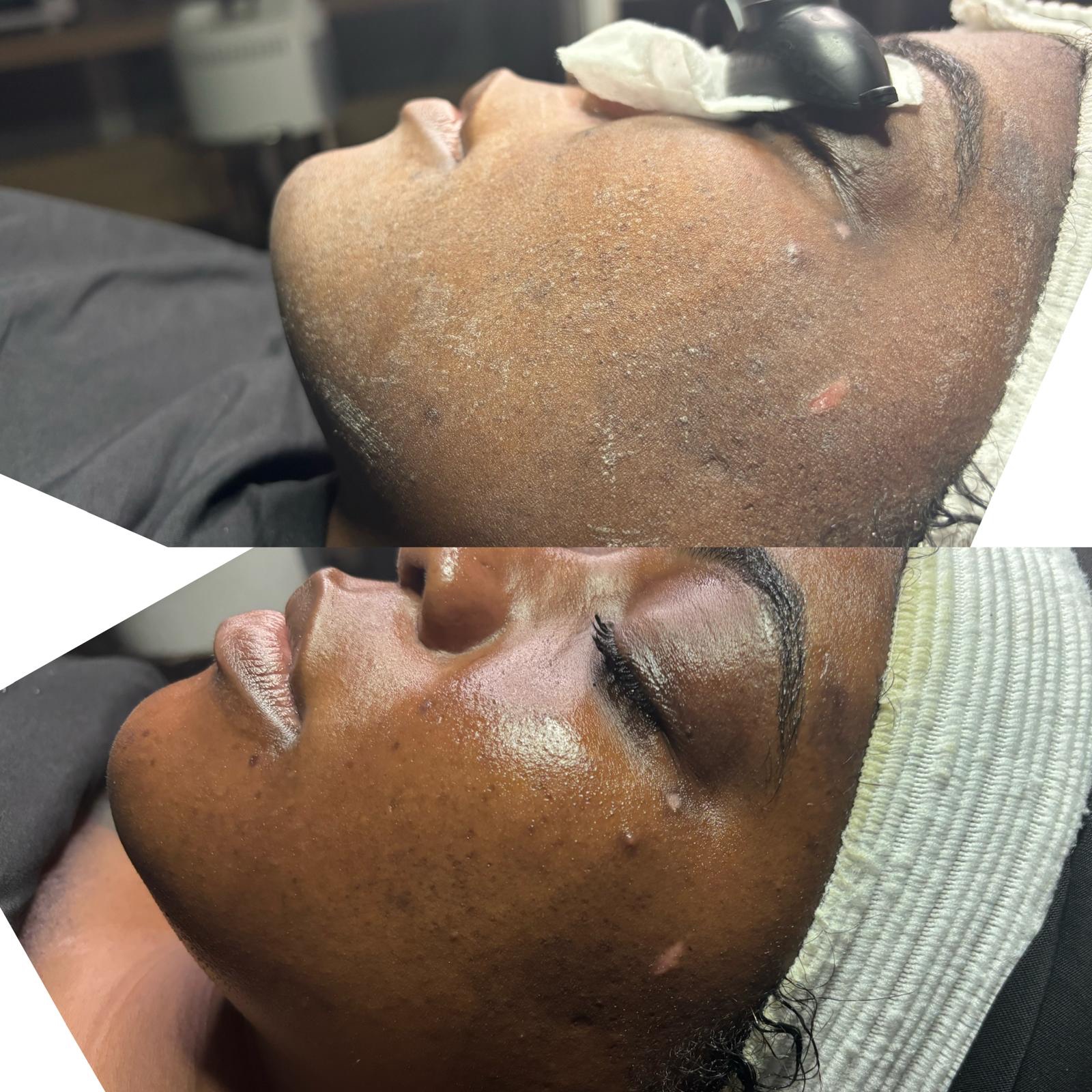 Thee Enhancer at Trale Beauty in Lewisville, TX