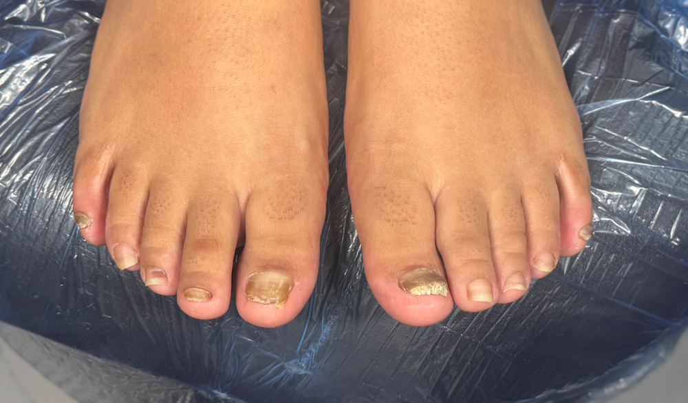 Mild Fungus Wellness Pedis