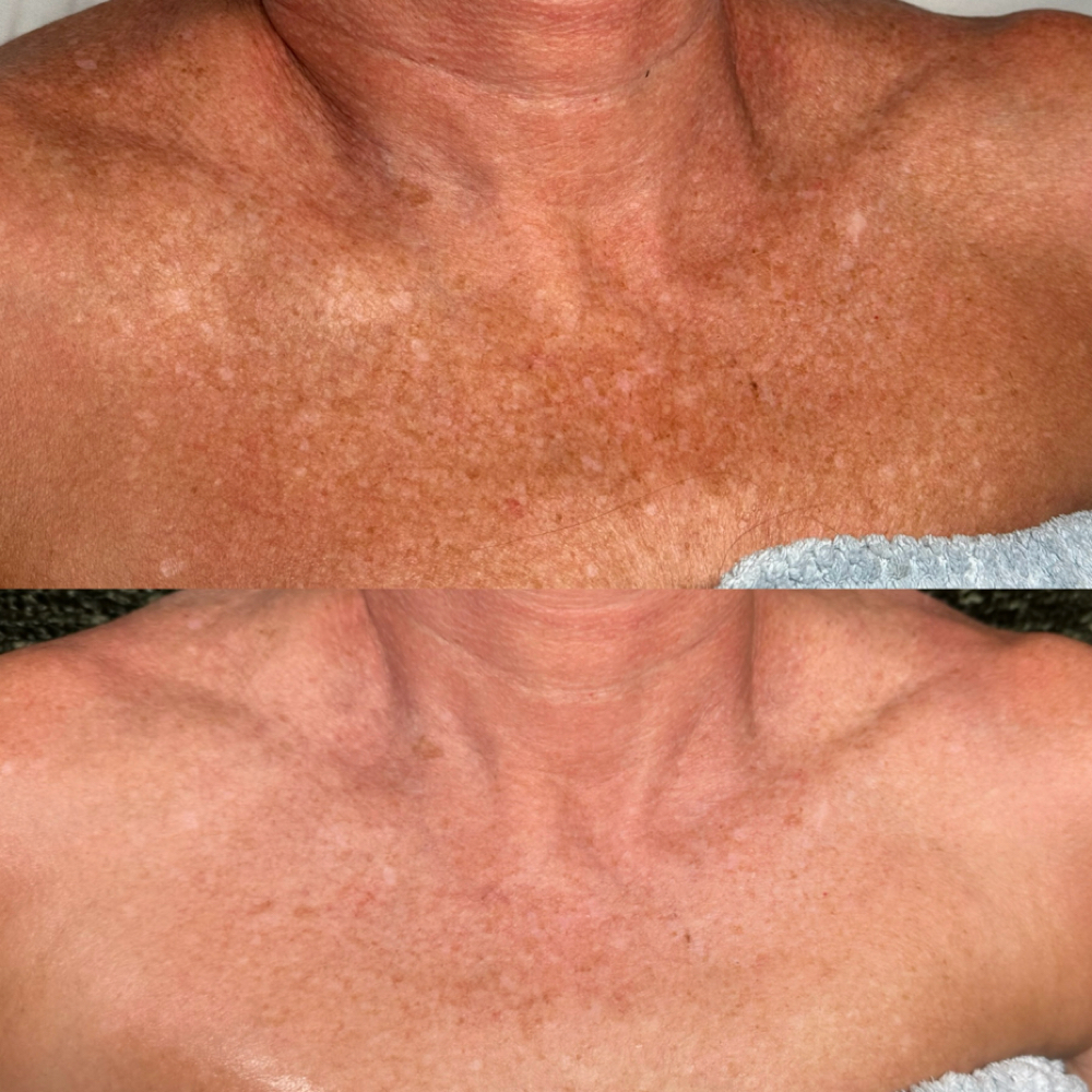 Procell Microchanneling Face + Neck at Skin Deep Esthetics in Columbus, MS