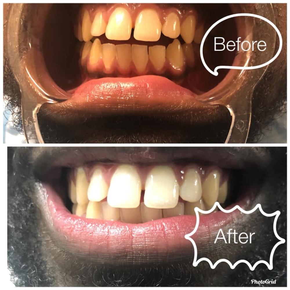 Premium Whitening at Shaqs Teeth Whitening in Tarboro, NC