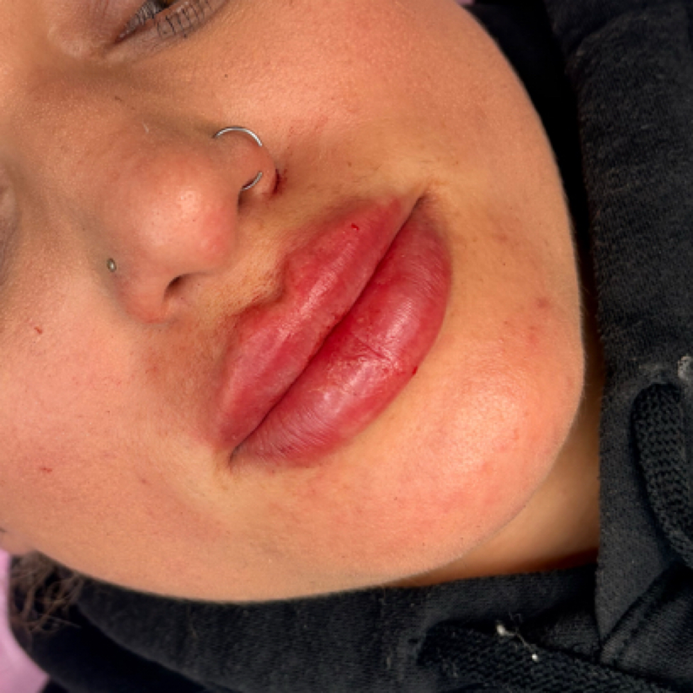 1.5 ML Lip Filler at Balance.Bar.Aesthetics in Berkeley, CA