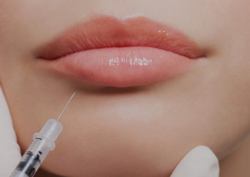 Lip Filler dissolution