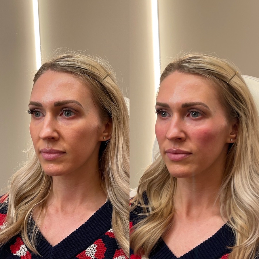 Cheek Filler