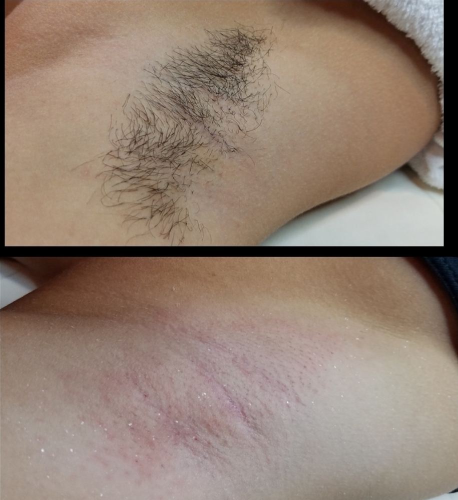 Underarm Wax