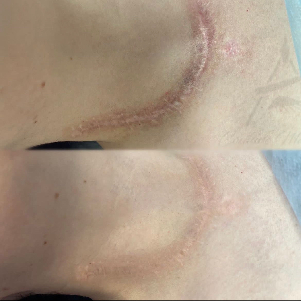 Scars at Ideal Ink Lab in Miami, FL