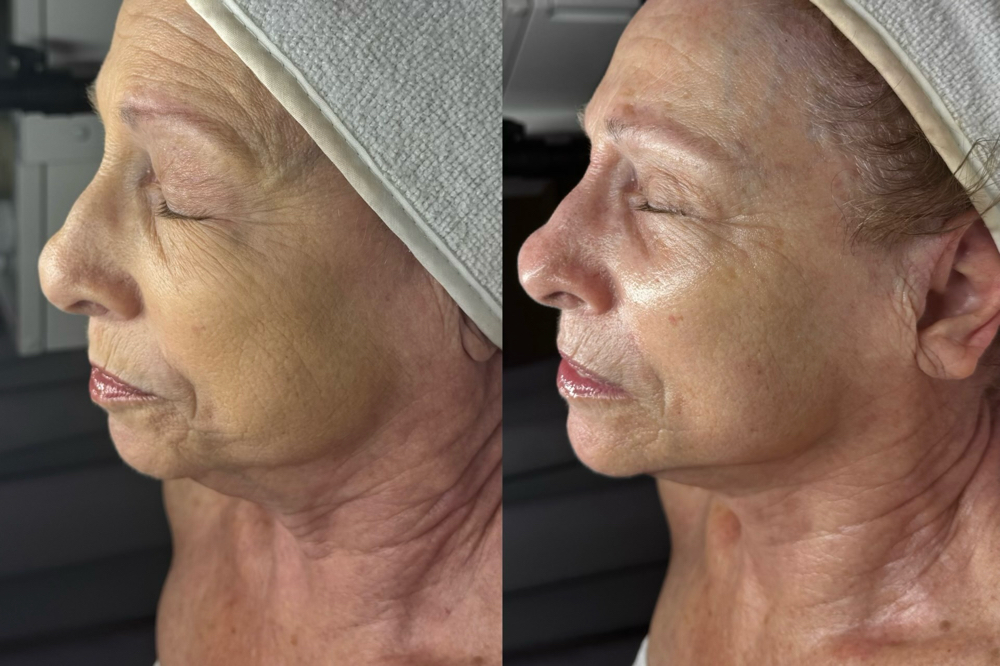 LUXE LIFT TREATMENT