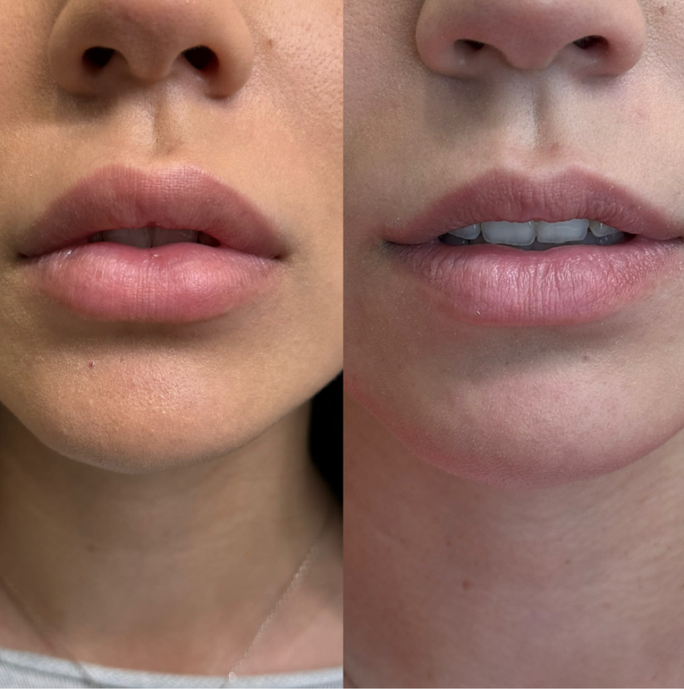 Dissolve and Refresh Treatment at Lace Skn in West Lake Hills, TX