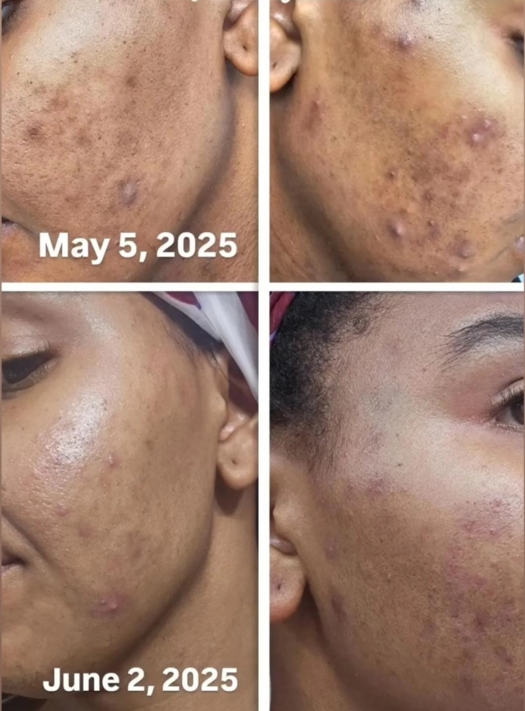 Acne Deep Pore Facial at Basic and Beyond Brows in Lakewood, CA