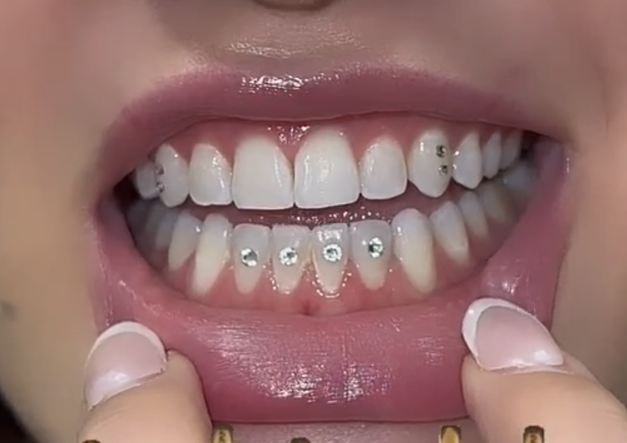 Iced Out (6-8 Teeth)