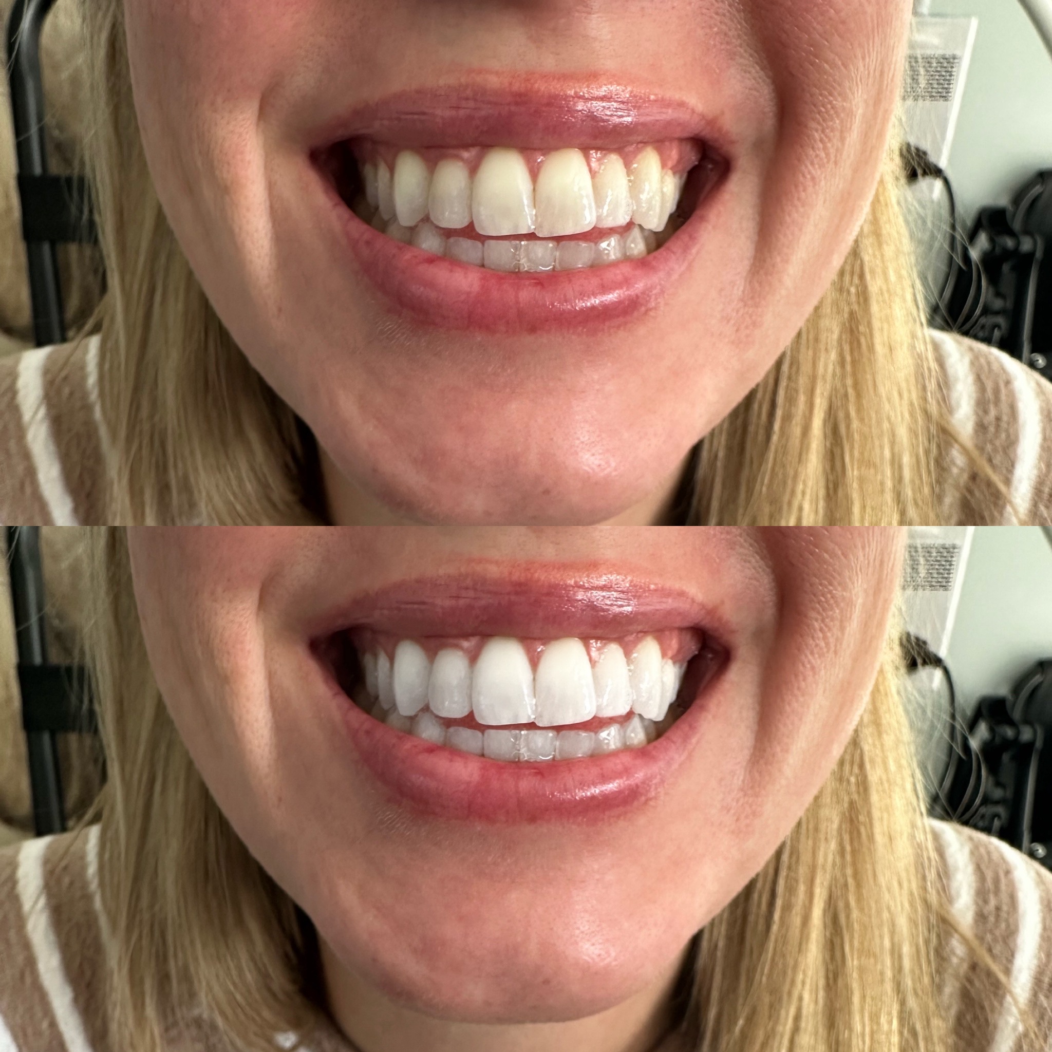 Premium Teeth Whitening Session