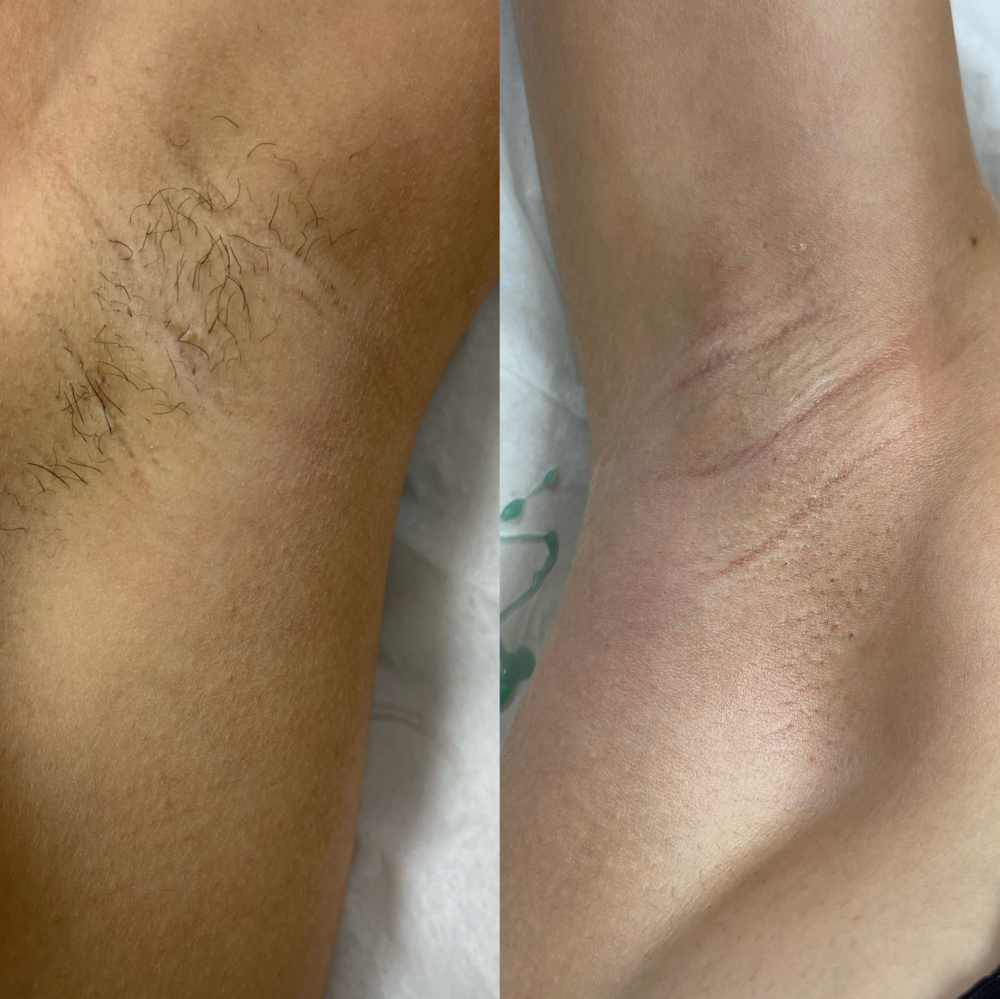 UNDERARM WAX at Belleza Skin in Tinley Park, IL