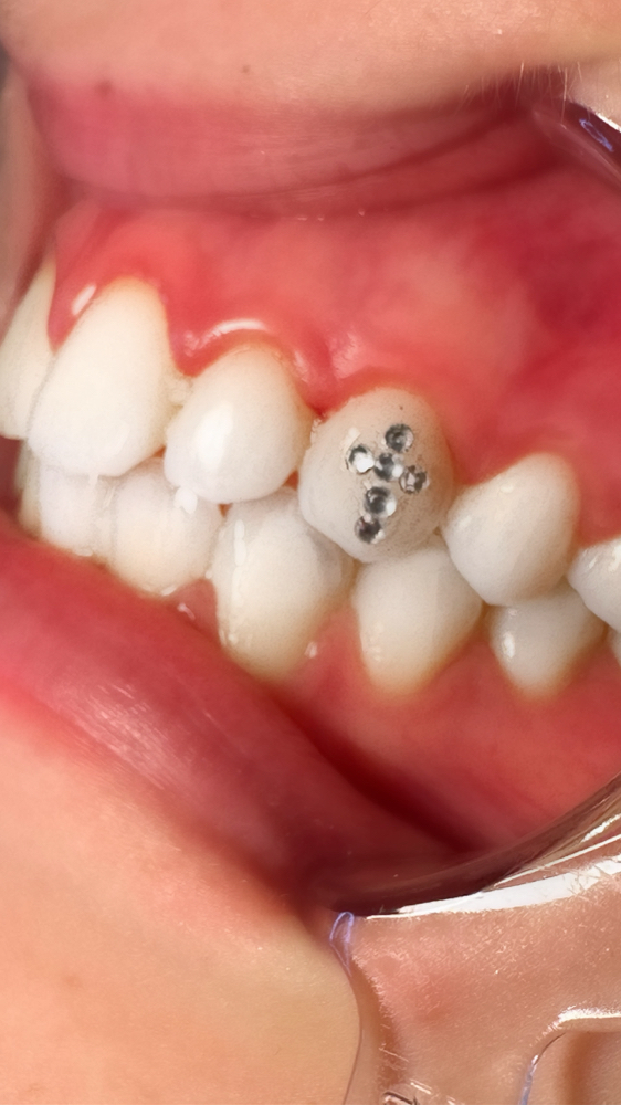Tooth Gems