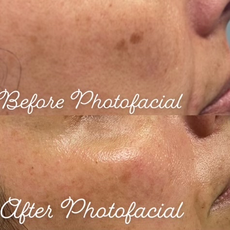 Photo Facial at Amy Donaldson Nurse Injector in Westport, MA