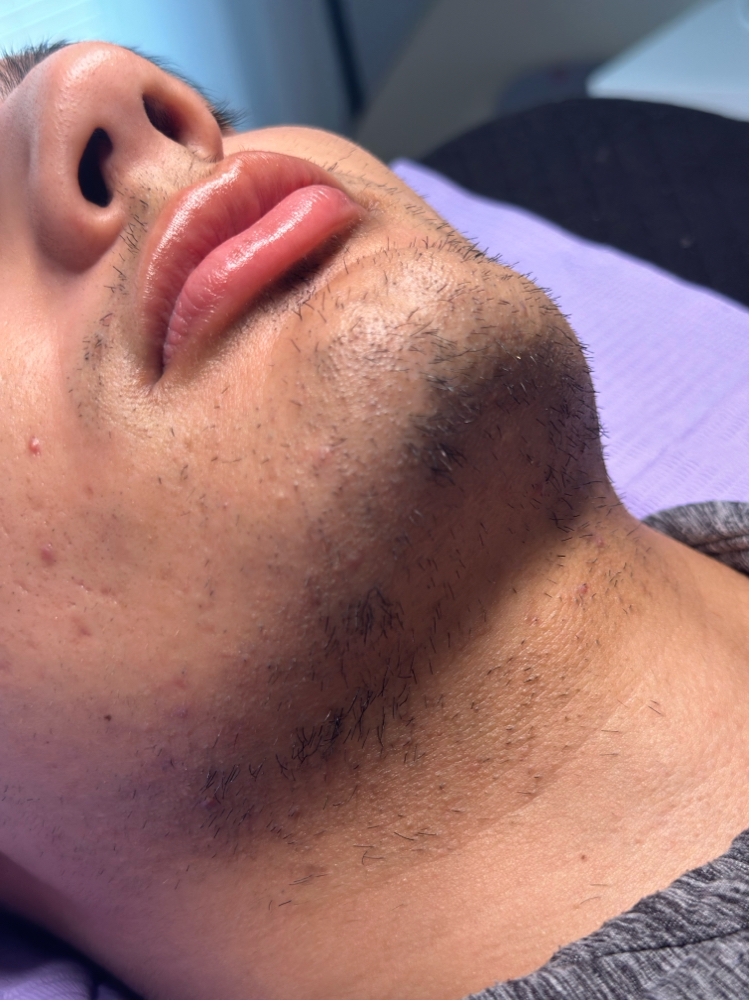 Beard Treament
