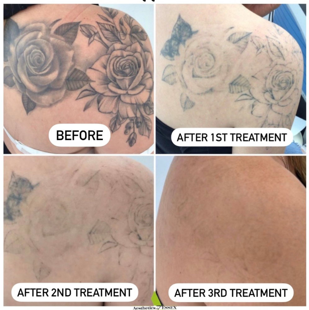 Permanent Makeup & Tattoo Removal