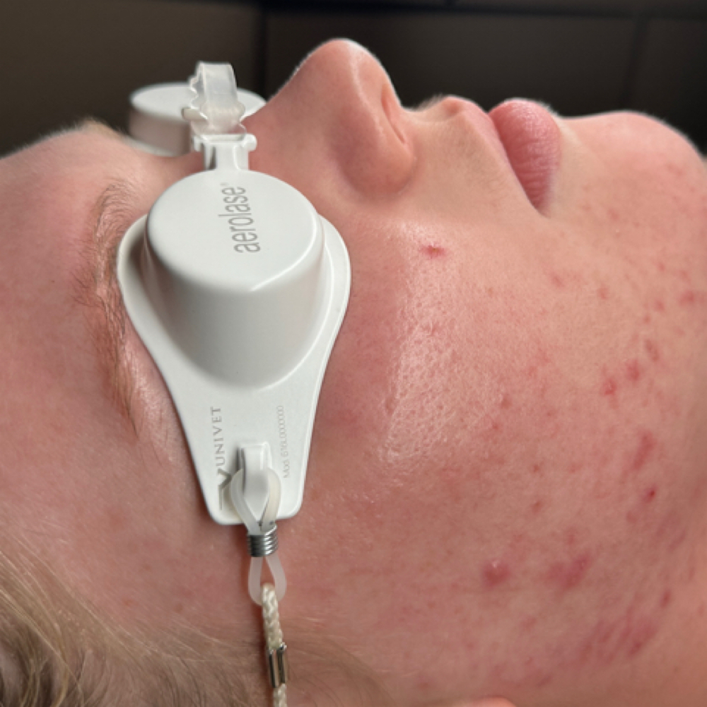 Advanced Acne Clearing Program