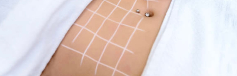 Mesotherapy at RÊVE in Stamford, CT