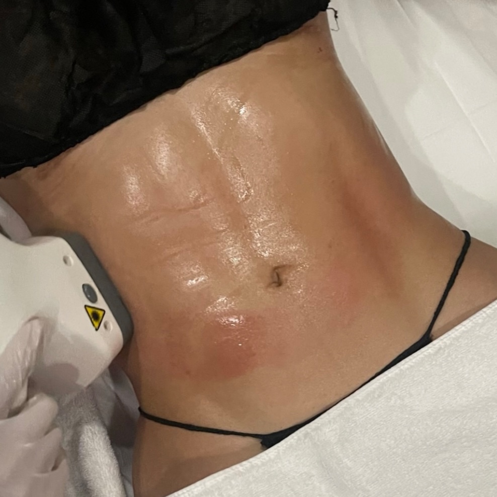 GOLDSHAPE FULL BODY at GOLD SKIN SPA AND BEAUTY in MCALLENT, TX