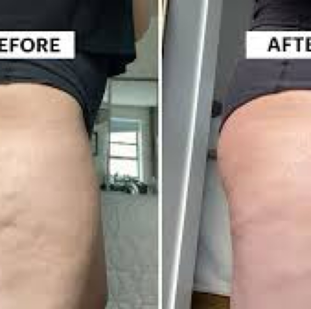 Cellu4D And Lipo4D at Luminous Beauty Studio in Gillette, WY