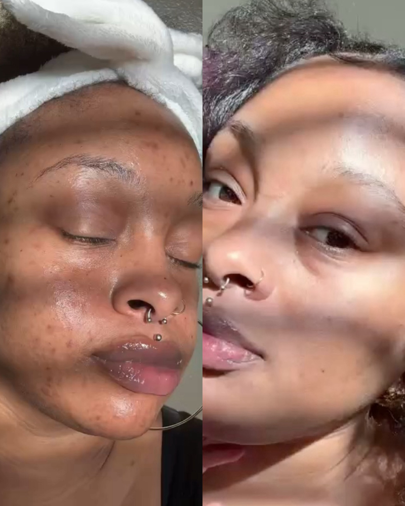 Microneedling