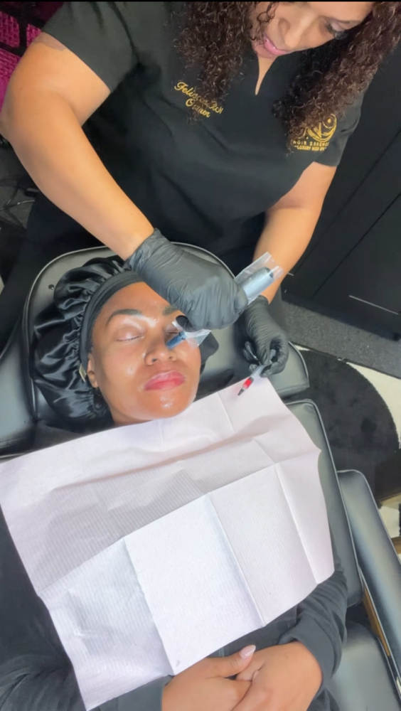 Microneedling