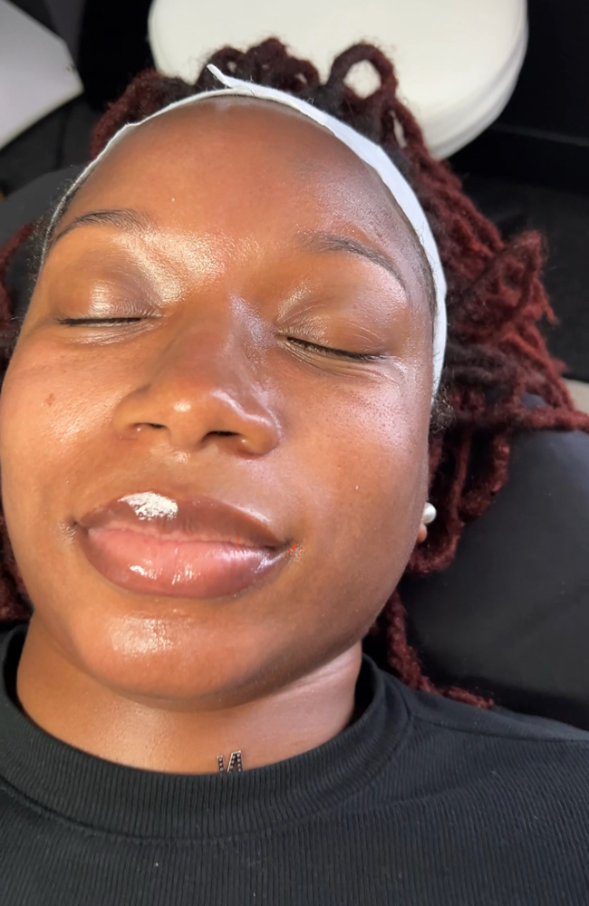 Botox Facial with Microneedling