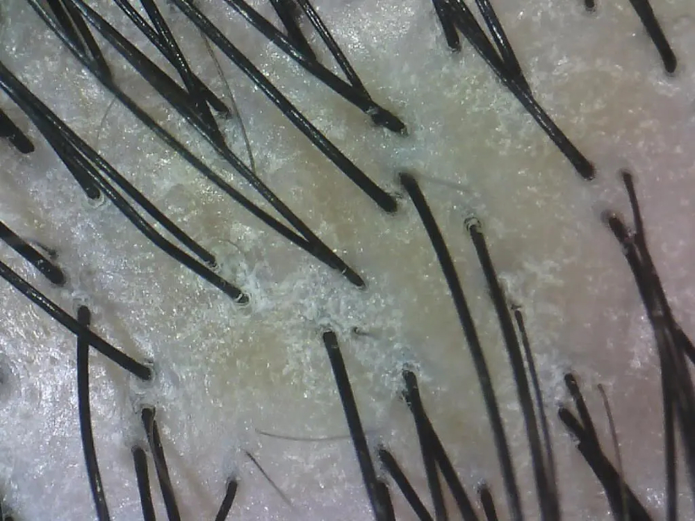 Scalp Screening (ADD-ON)