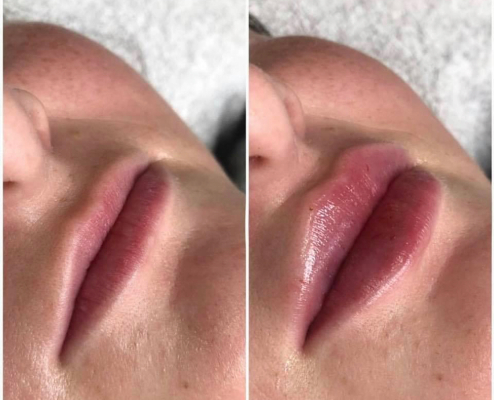 Hyaluron Pen Lip Fillers