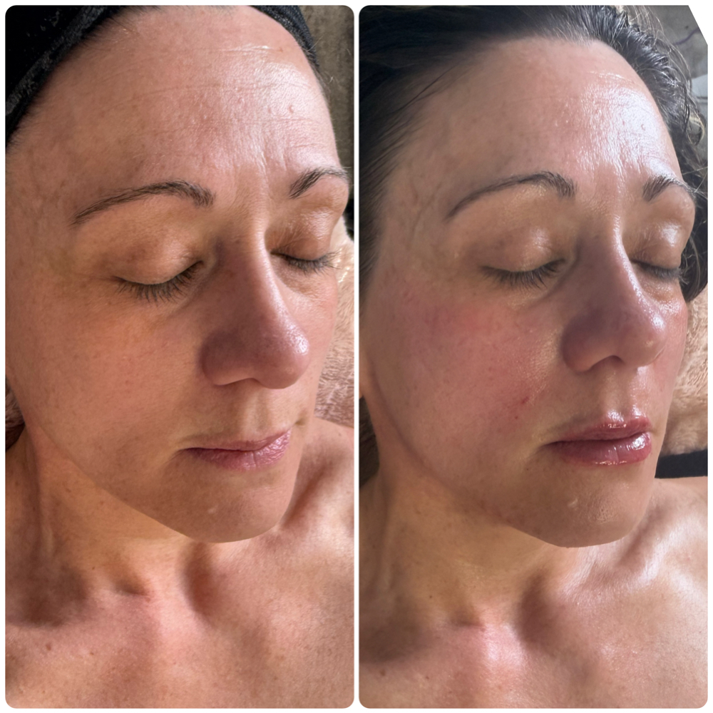 3 Syringe Deal at Lavish Beauty Bar in Strasburg, CO