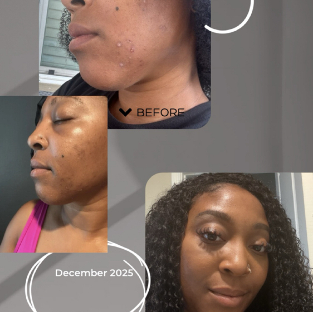 Correct & Reset at Halo & Co Esthetics in San Antonio, TX
